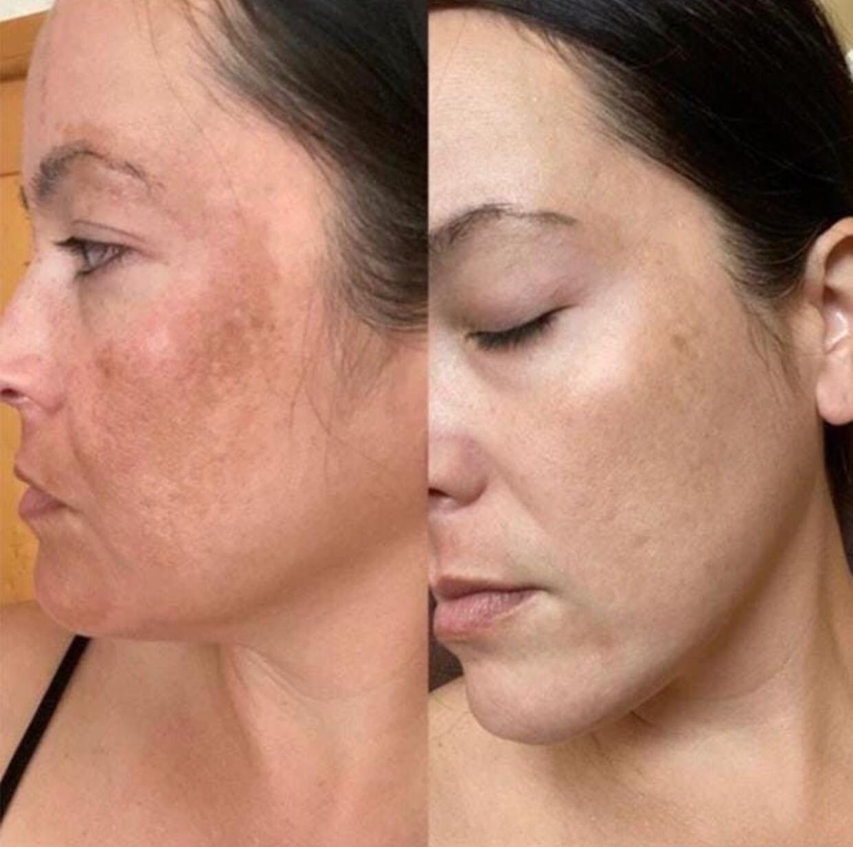 Antes e depois: manchas do rosto mais suaves após o uso dos séruns