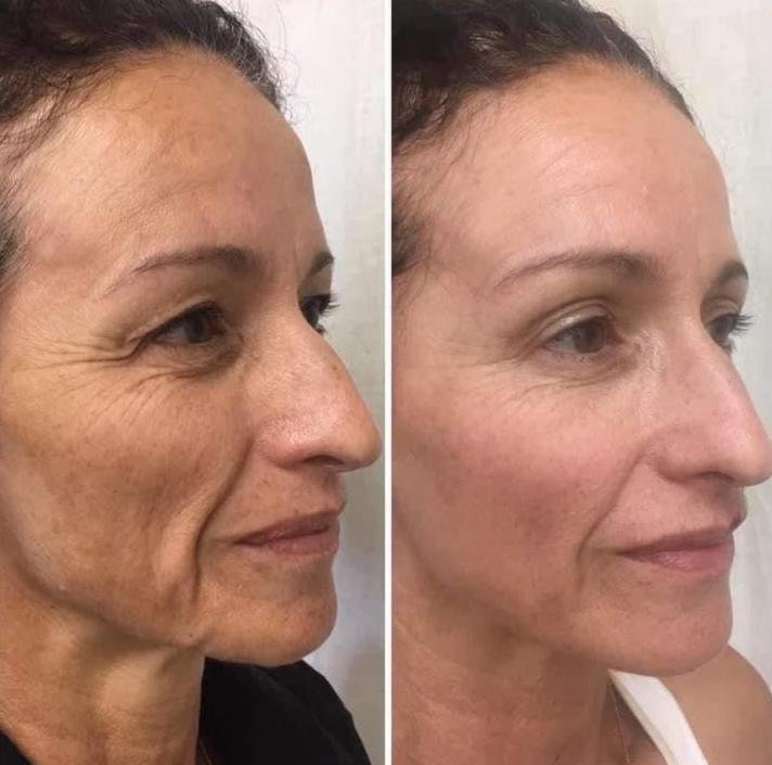 Antes e depois: linhas finas mais suaves e pele mais viçosa