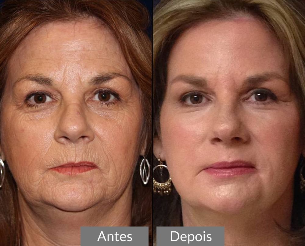 Antes e depois: pele mais firme e uniforme no rosto